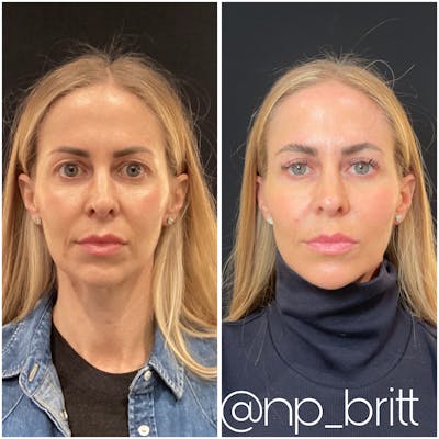 Fillers Before & After Gallery - Patient 217679 - Image 1