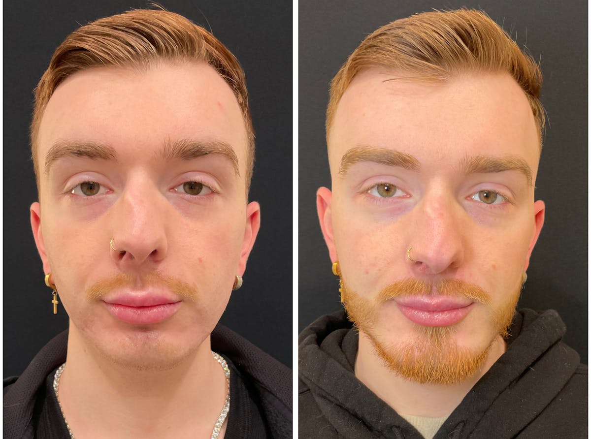 Fillers Before & After Gallery - Patient 195375 - Image 1