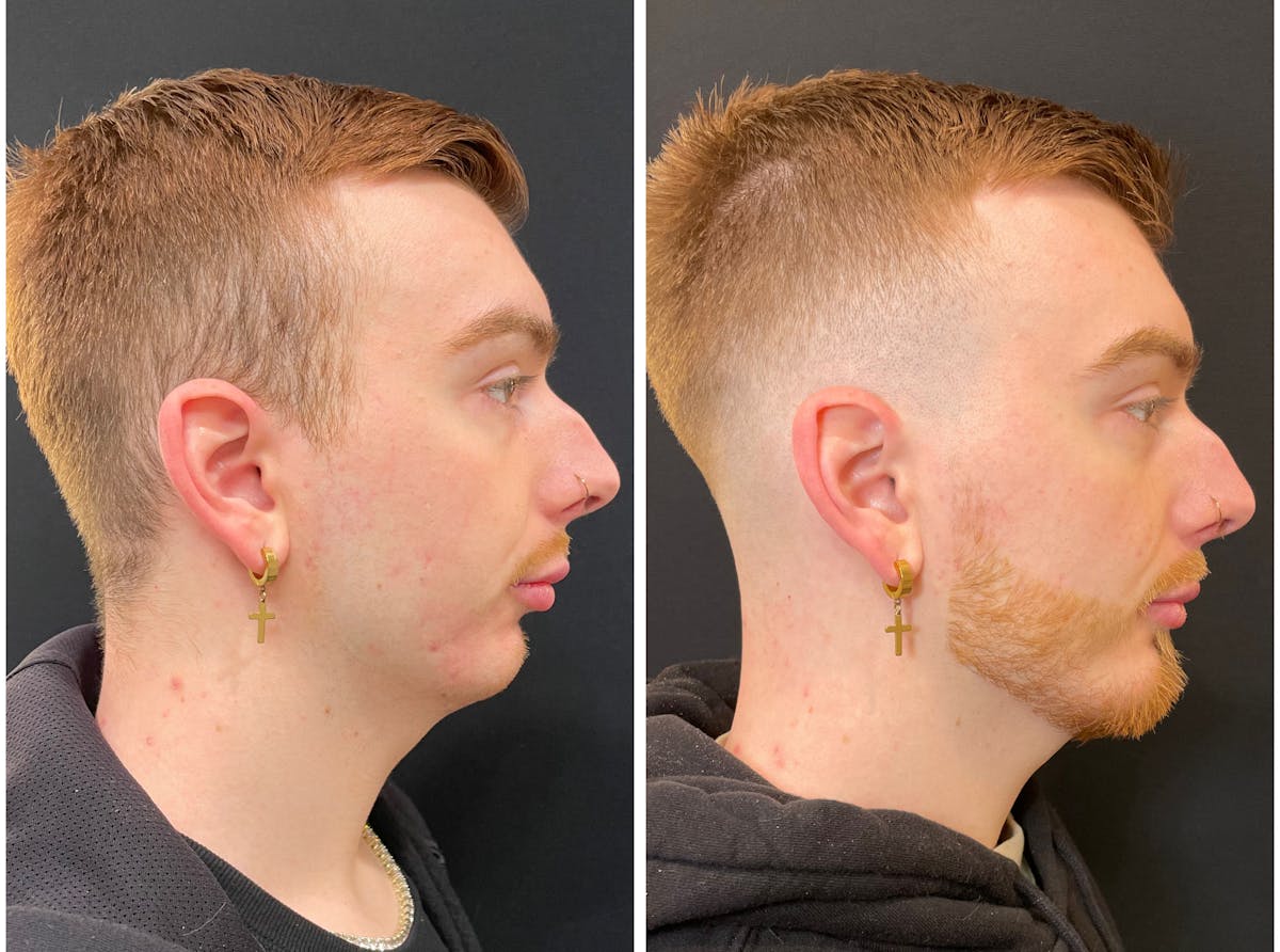 Fillers Before & After Gallery - Patient 195375 - Image 3