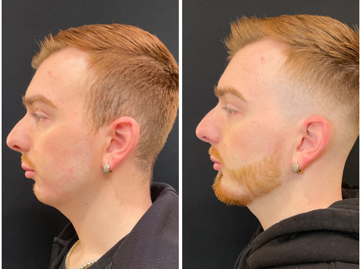 Fillers Before & After Gallery - Patient 195375 - Image 5