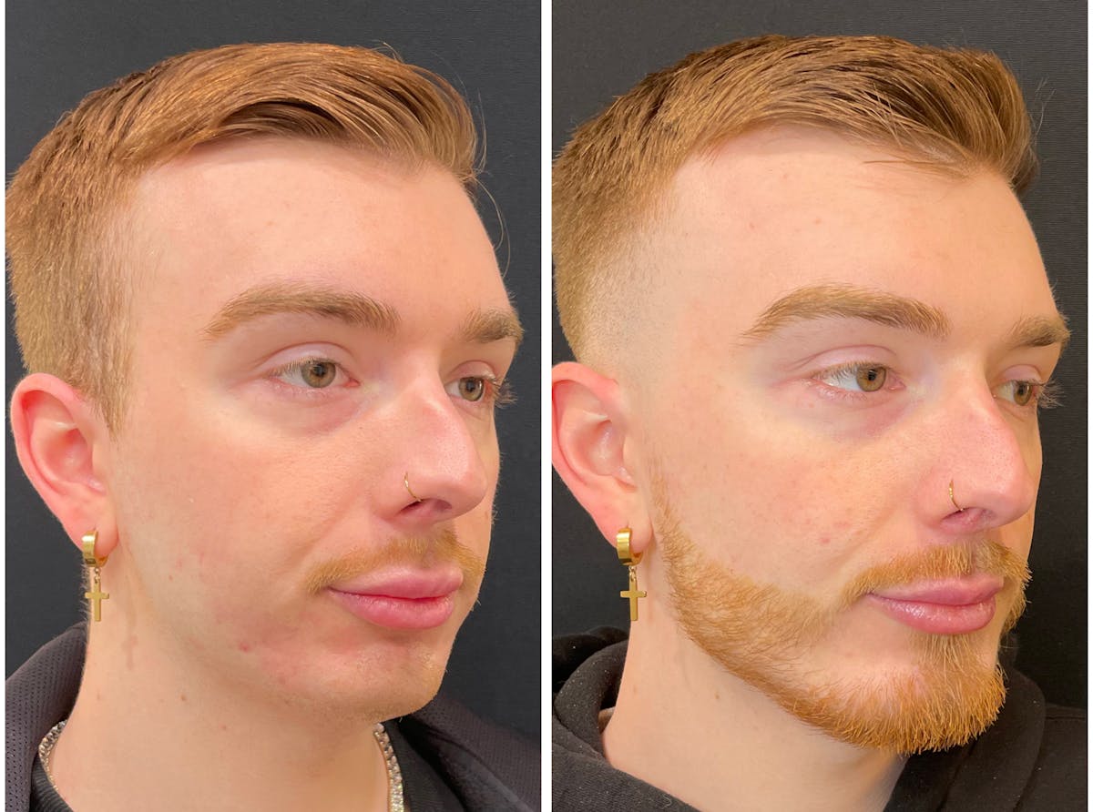 Fillers Before & After Gallery - Patient 195375 - Image 2