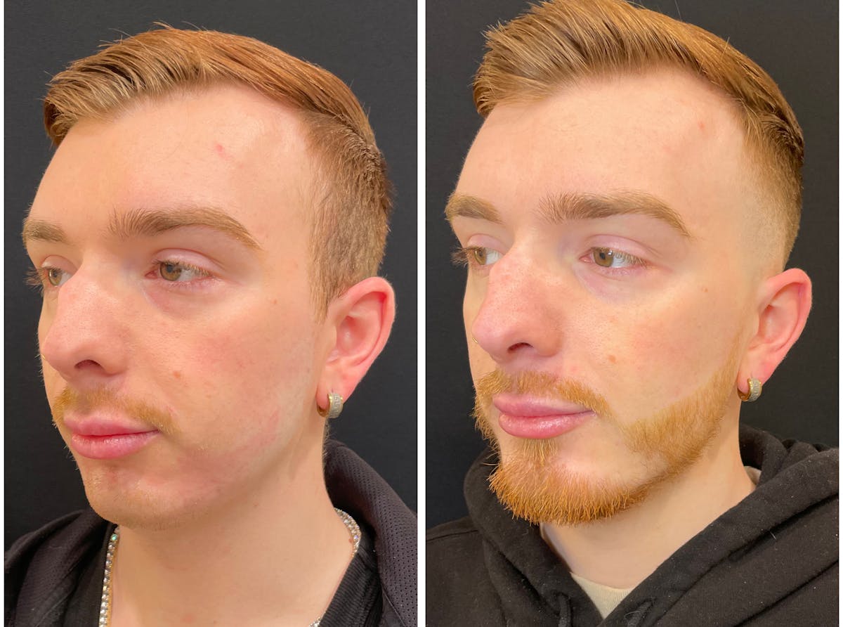 Fillers Before & After Gallery - Patient 195375 - Image 4