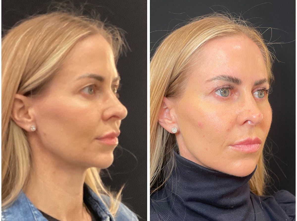 Fillers Before & After Gallery - Patient 217679 - Image 2