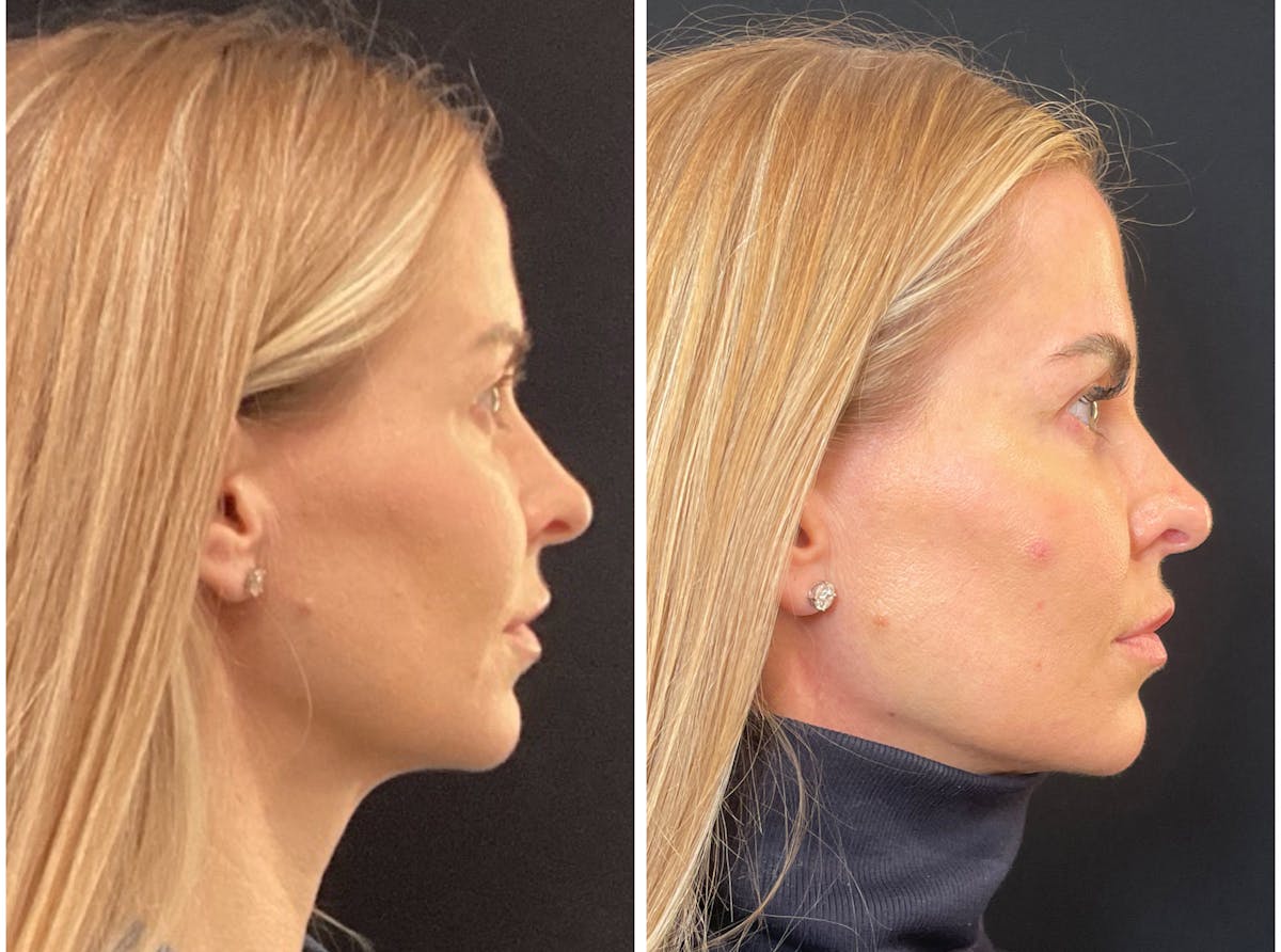 Fillers Before & After Gallery - Patient 217679 - Image 3