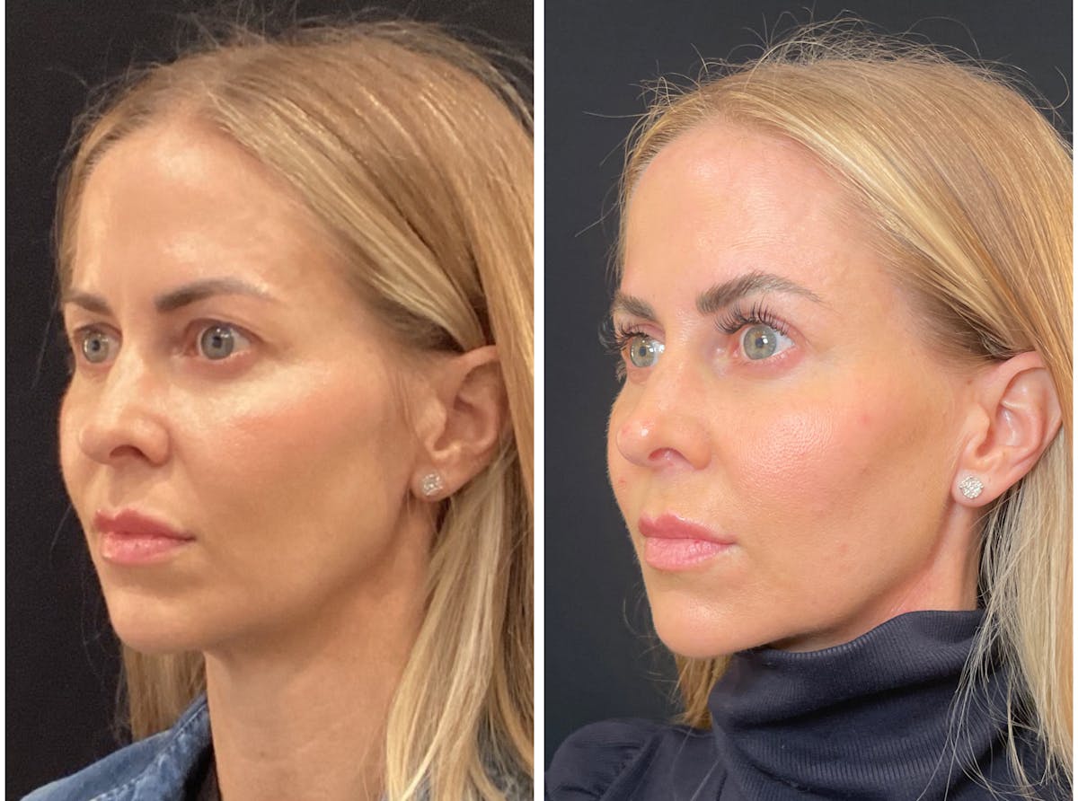 Fillers Before & After Gallery - Patient 217679 - Image 4