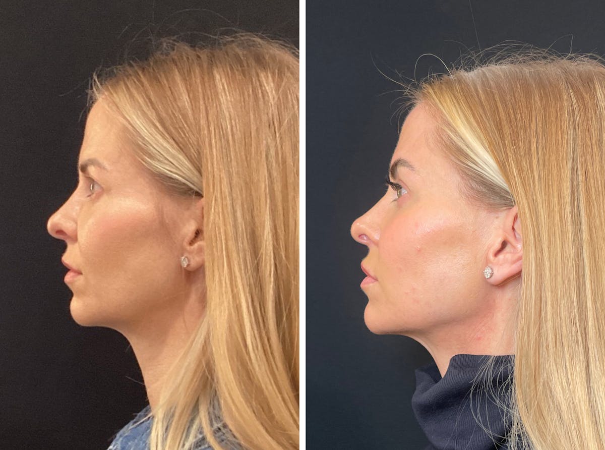 Fillers Before & After Gallery - Patient 217679 - Image 5