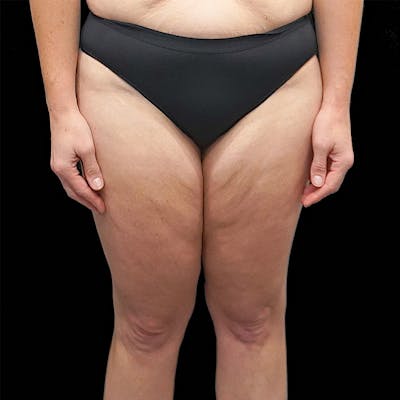 Thigh Lift Before & After Gallery - Patient 262357 - Image 1