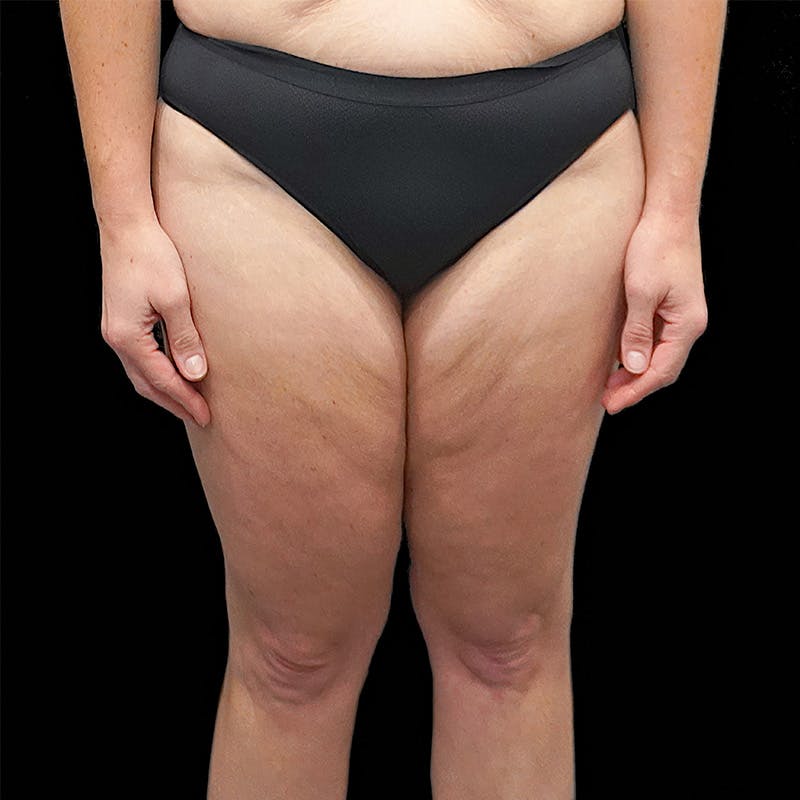 Thigh Lift Before & After Gallery - Patient 262357 - Image 1