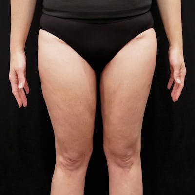 Thigh Lift Before & After Gallery - Patient 262357 - Image 2