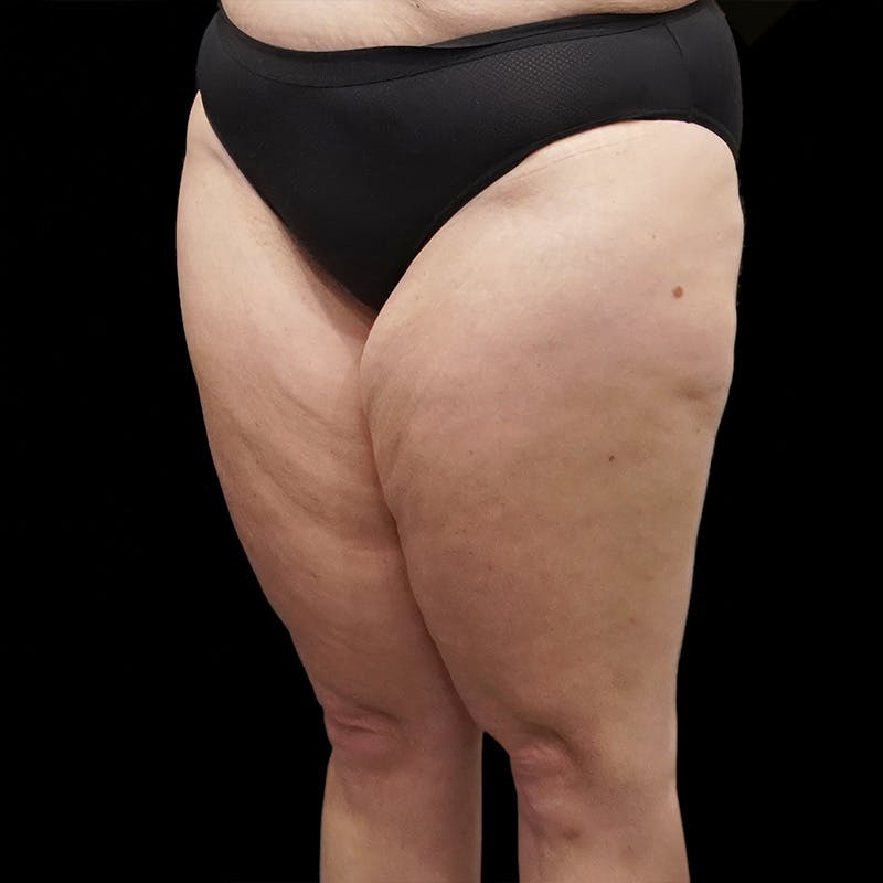 Thigh Lift Before & After Gallery - Patient 262357 - Image 3
