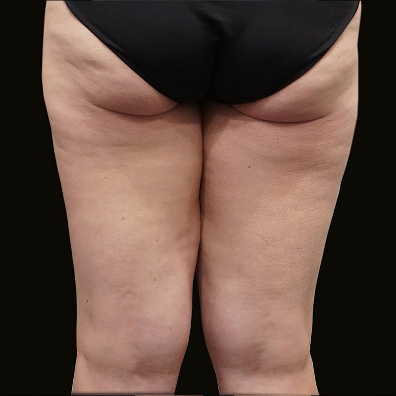 Thigh Lift Before & After Gallery - Patient 262357 - Image 5