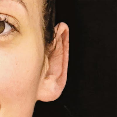 Otoplasty Before & After Gallery - Patient 417499 - Image 2