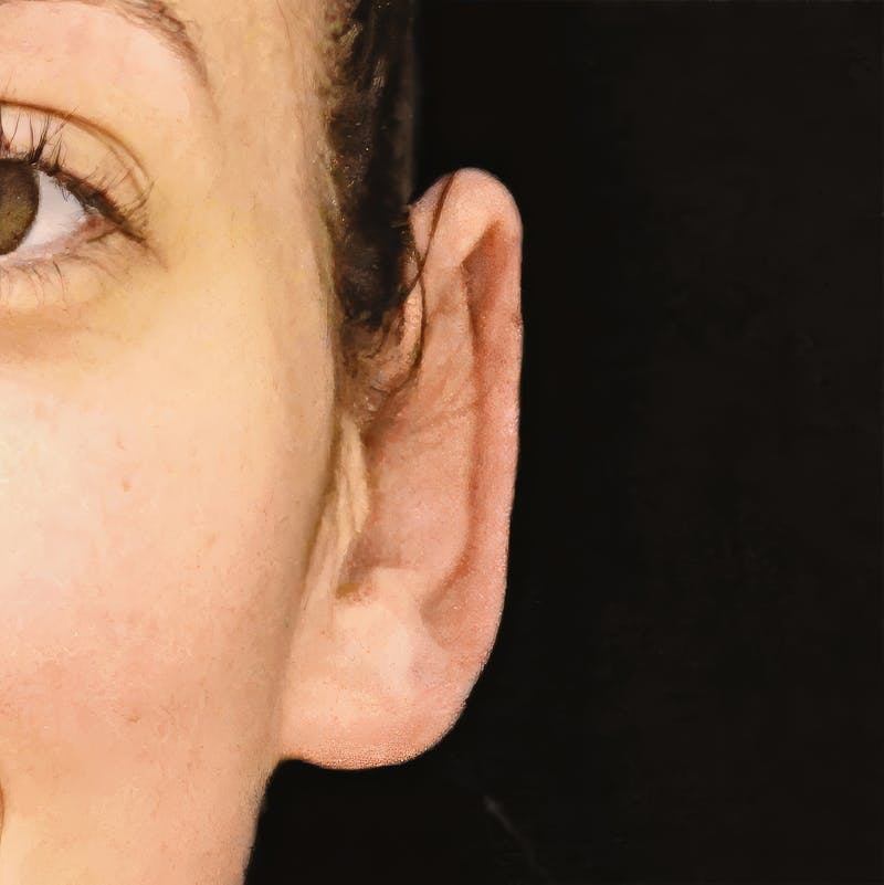 Otoplasty Before & After Gallery - Patient 417499 - Image 2