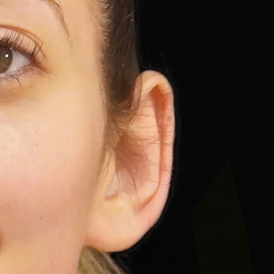 Otoplasty Before & After Gallery - Patient 417499 - Image 1