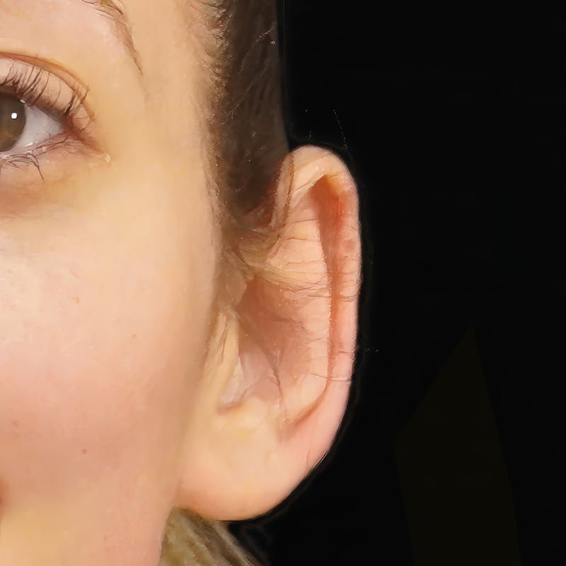 Otoplasty Before & After Gallery - Patient 417499 - Image 1