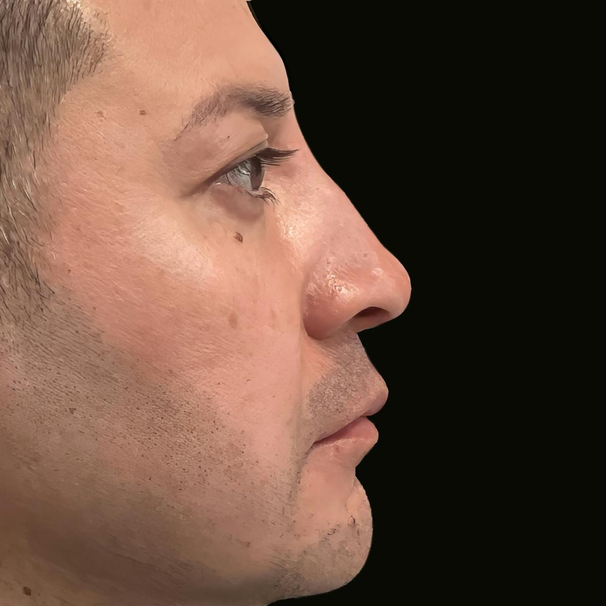 Fillers Before & After Gallery - Patient 412237 - Image 2