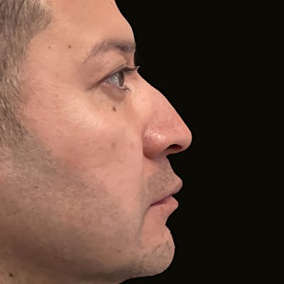 Fillers Before & After Gallery - Patient 412237 - Image 1