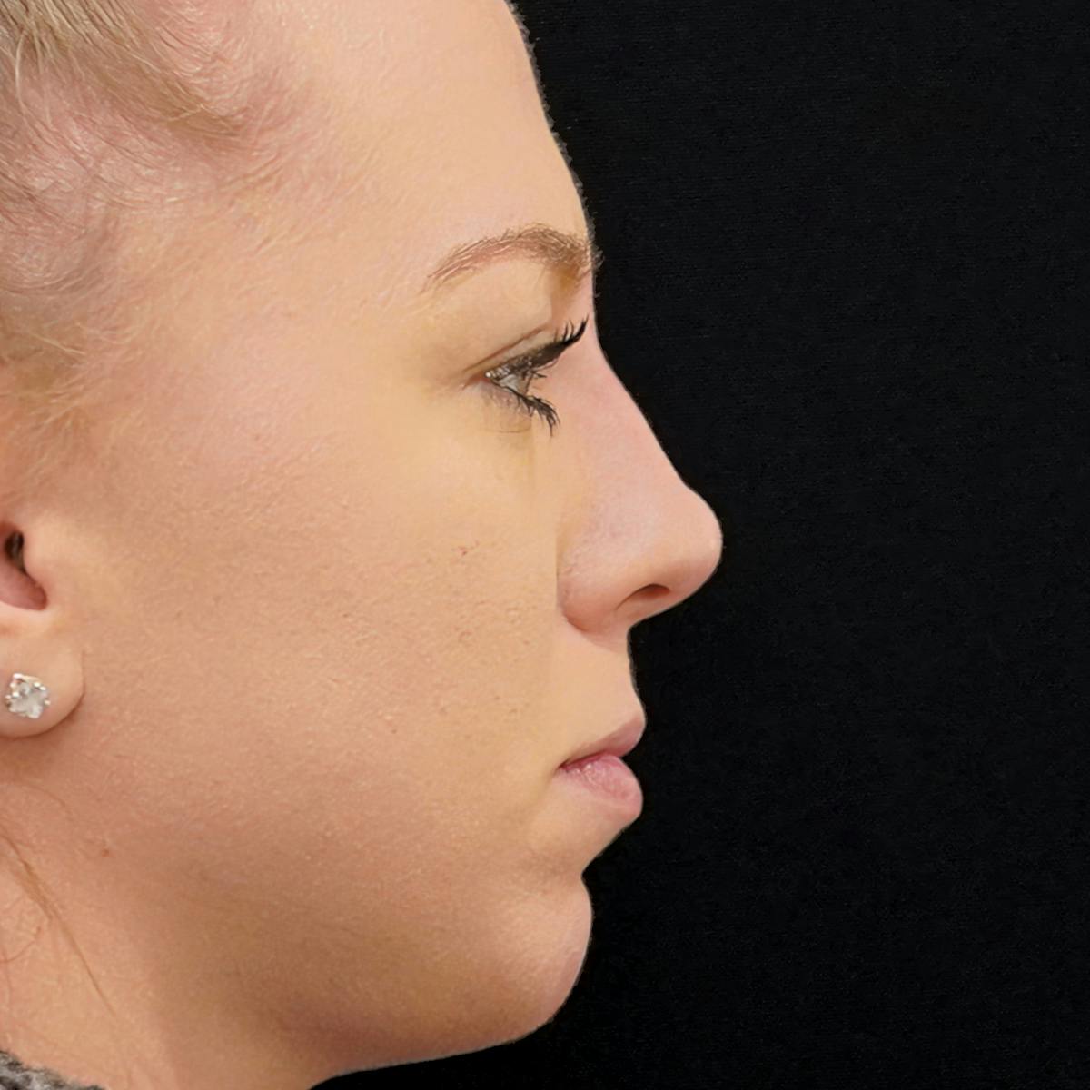 Fillers Before & After Gallery - Patient 343744 - Image 2
