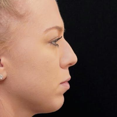 Fillers Before & After Gallery - Patient 343744 - Image 1