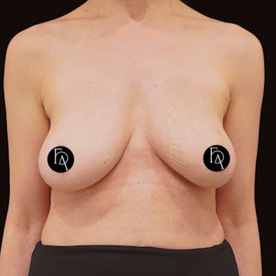 Breast Implant Removal Before & After Gallery - Patient 371606 - Image 1