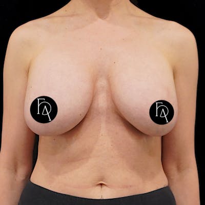 Breast Implant Removal Before & After Gallery - Patient 371606 - Image 2