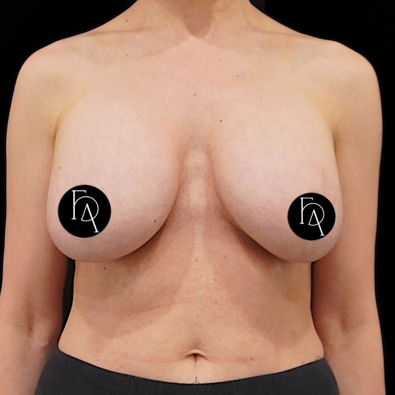 Breast Implant Removal Before & After Gallery - Patient 371606 - Image 2