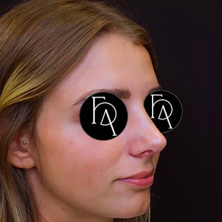 Rhinoplasty Before & After Gallery - Patient 204068 - Image 2