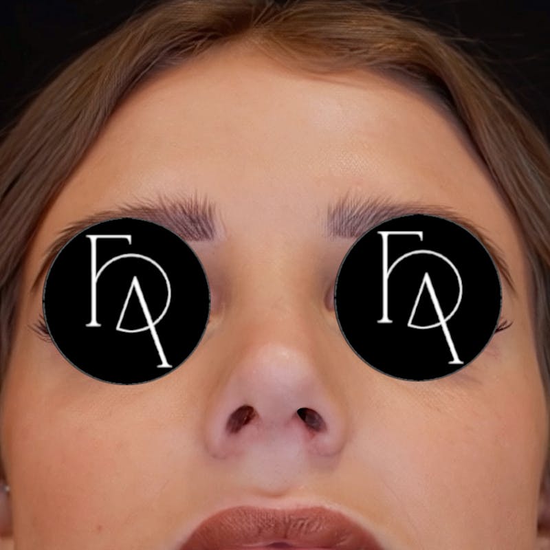 Rhinoplasty Before & After Gallery - Patient 204068 - Image 3