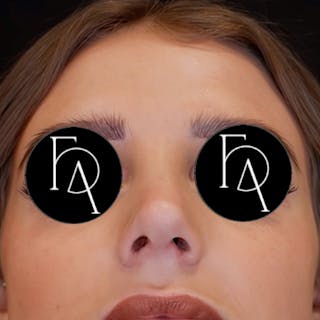 Rhinoplasty Before & After Gallery - Patient 204068 - Image 4