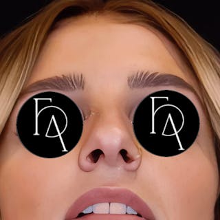 Rhinoplasty Before & After Gallery - Patient 204068 - Image 4