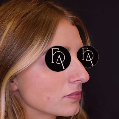 Rhinoplasty Before & After Gallery - Patient 204068 - Image 1