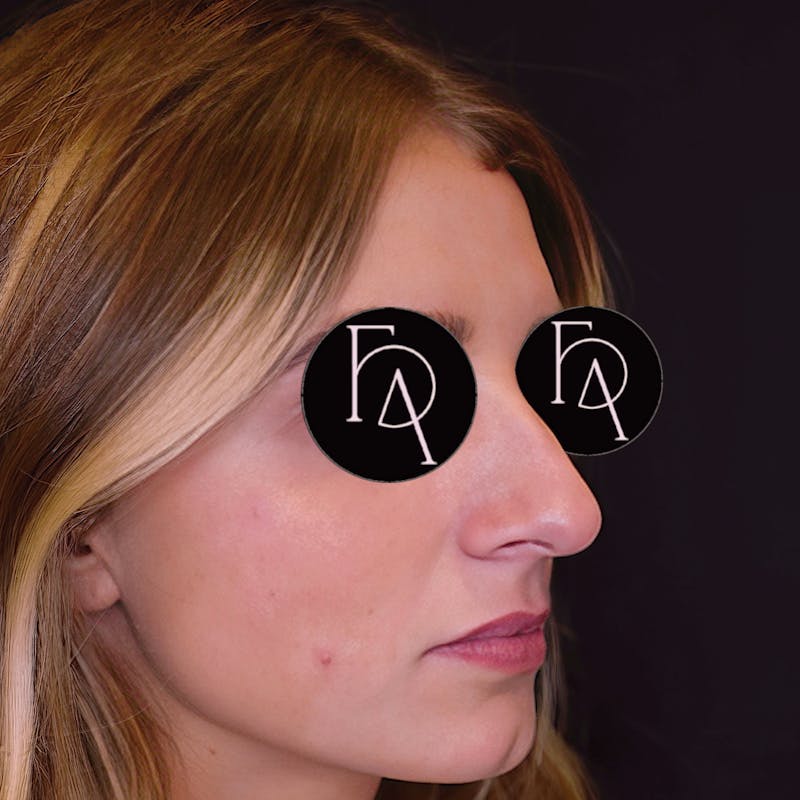 Rhinoplasty Before & After Gallery - Patient 204068 - Image 1