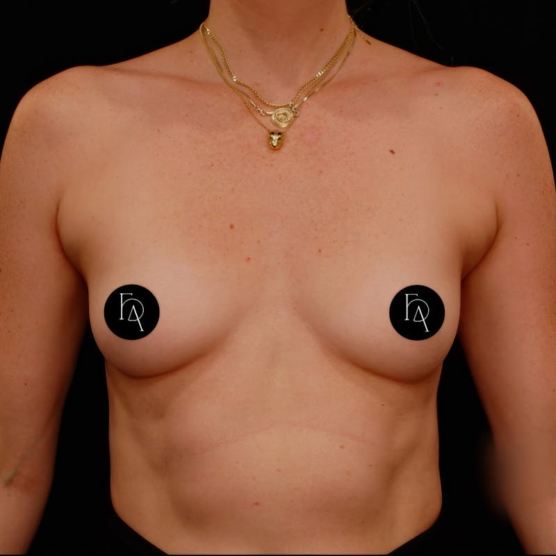 Breast Augmentation Before & After Gallery - Patient 191634 - Image 1