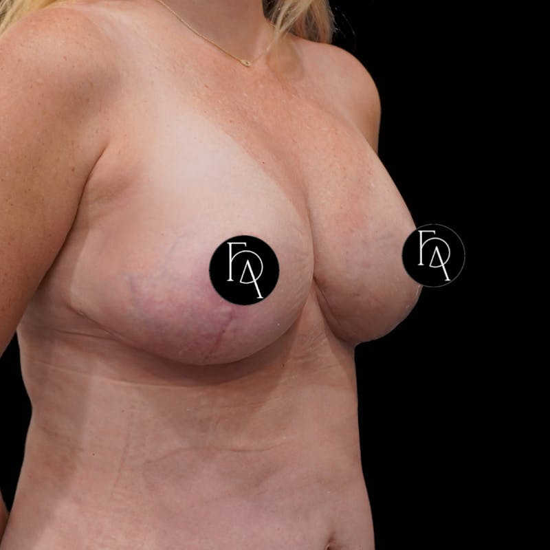Breast Lift (Mastopexy) Before & After Gallery - Patient 272174 - Image 4