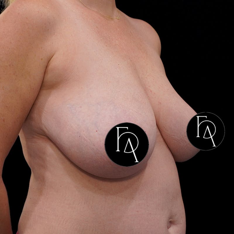 Breast Lift (Mastopexy) Before & After Gallery - Patient 272174 - Image 3