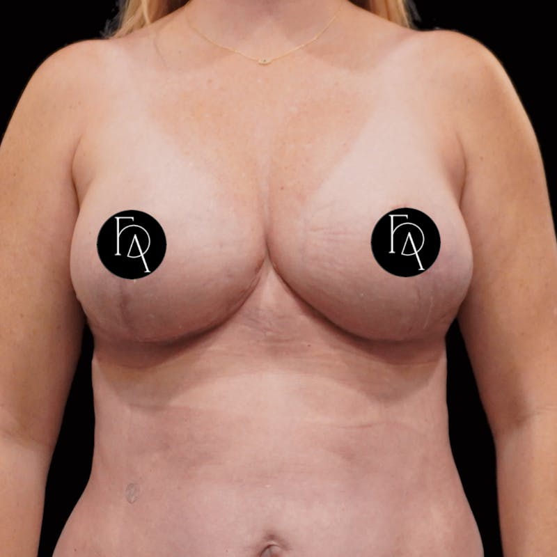 Breast Lift (Mastopexy) Before & After Gallery - Patient 272174 - Image 2