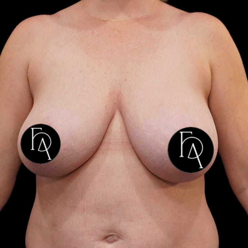 Breast Lift (Mastopexy) Before & After Gallery - Patient 272174 - Image 1