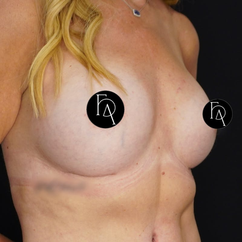 Breast Fat Grafting Before & After Gallery - Patient 181456 - Image 4