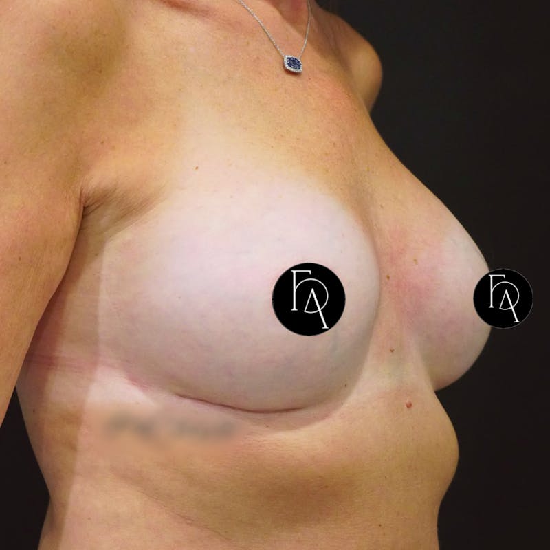 Breast Fat Grafting Before & After Gallery - Patient 181456 - Image 3