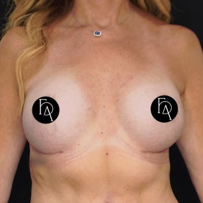 Breast Fat Grafting Before & After Gallery - Patient 181456 - Image 2