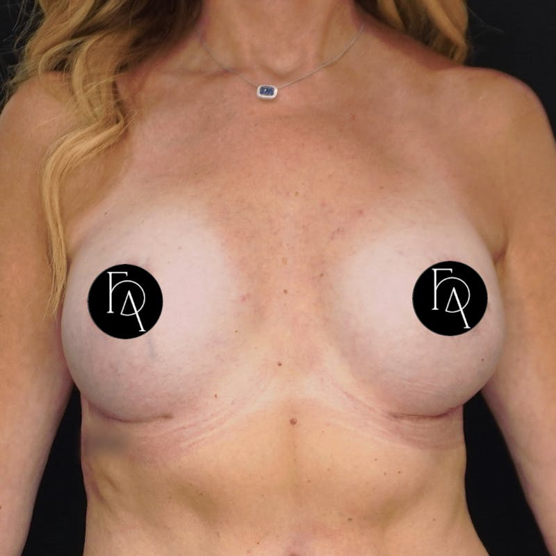 Breast Fat Grafting Before & After Gallery - Patient 181456 - Image 2