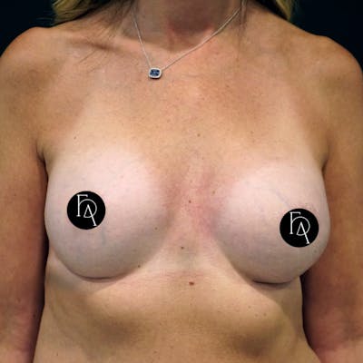 Breast Fat Grafting Before & After Gallery - Patient 181456 - Image 1