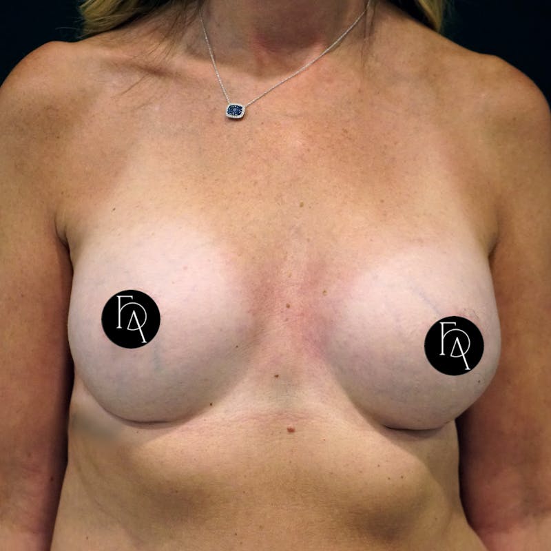 Breast Fat Grafting Before & After Gallery - Patient 181456 - Image 1