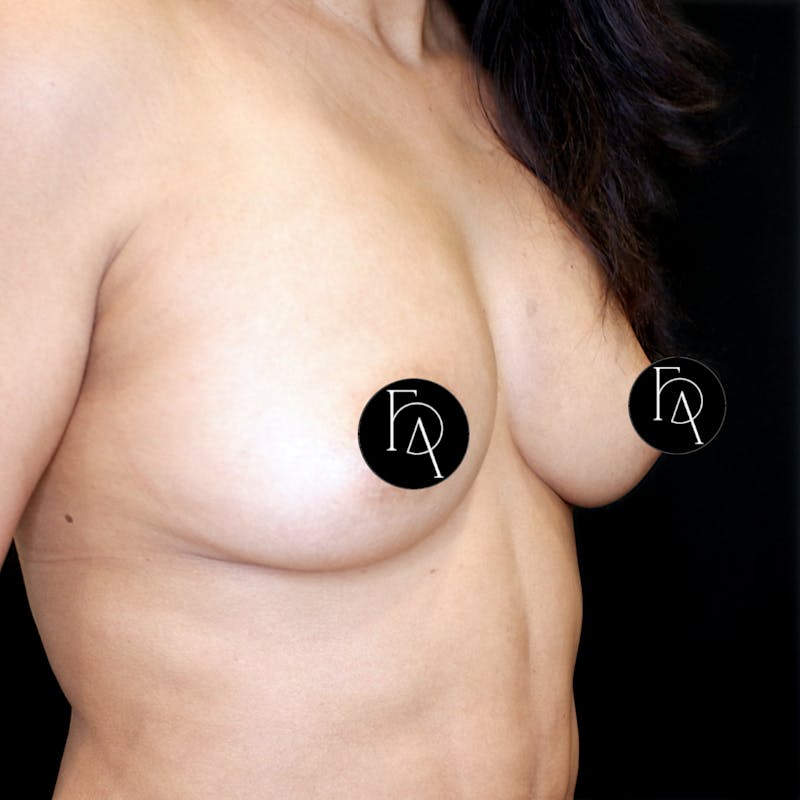Breast Fat Grafting Before & After Gallery - Patient 413866 - Image 4