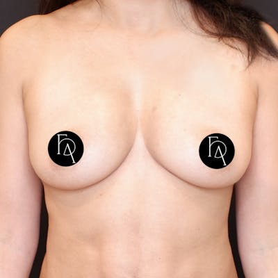 Breast Fat Grafting Before & After Gallery - Patient 413866 - Image 2