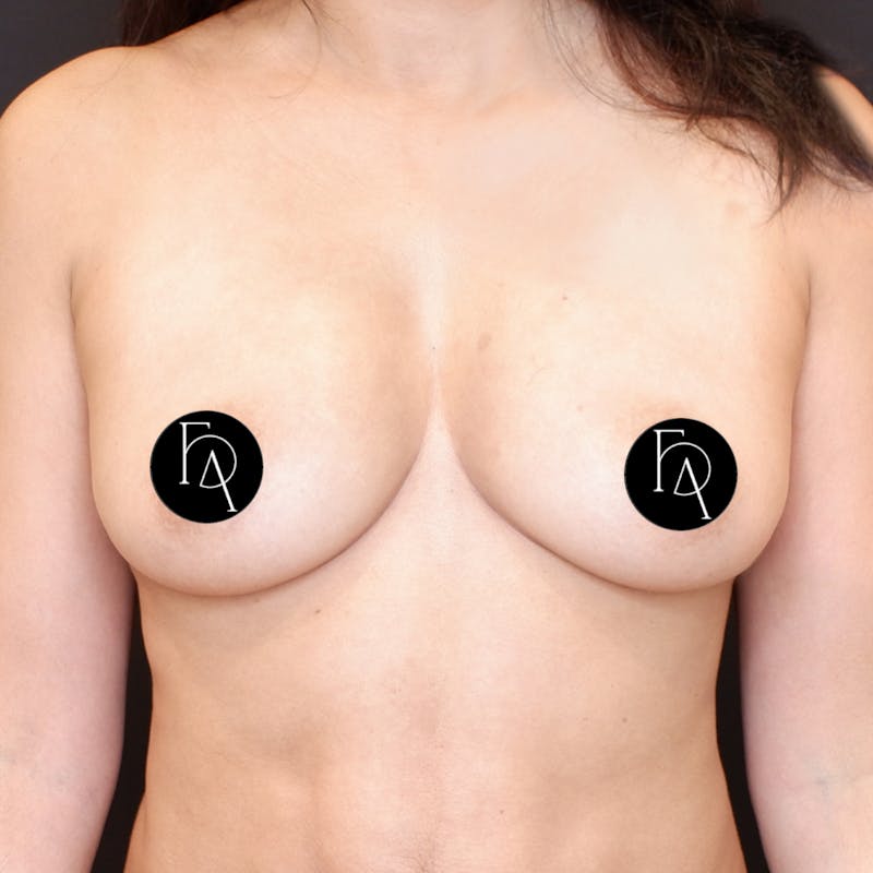 Breast Fat Grafting Before & After Gallery - Patient 413866 - Image 2