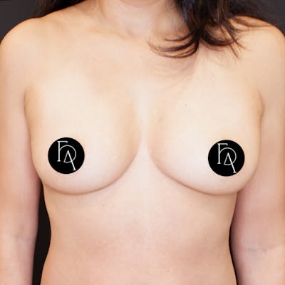 Breast Fat Grafting Before & After Gallery - Patient 413866 - Image 1