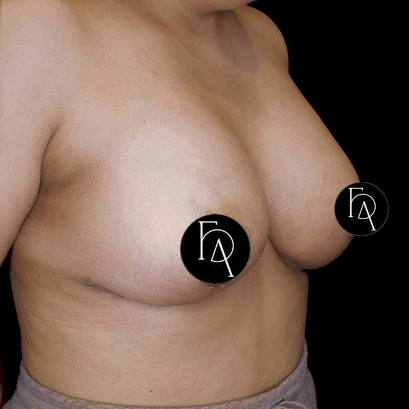 Breast Lift + Augmentation Before & After Gallery - Patient 685272 - Image 4