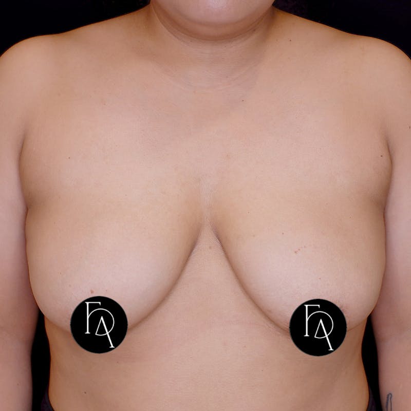 Breast Lift + Augmentation Before & After Gallery - Patient 685272 - Image 1