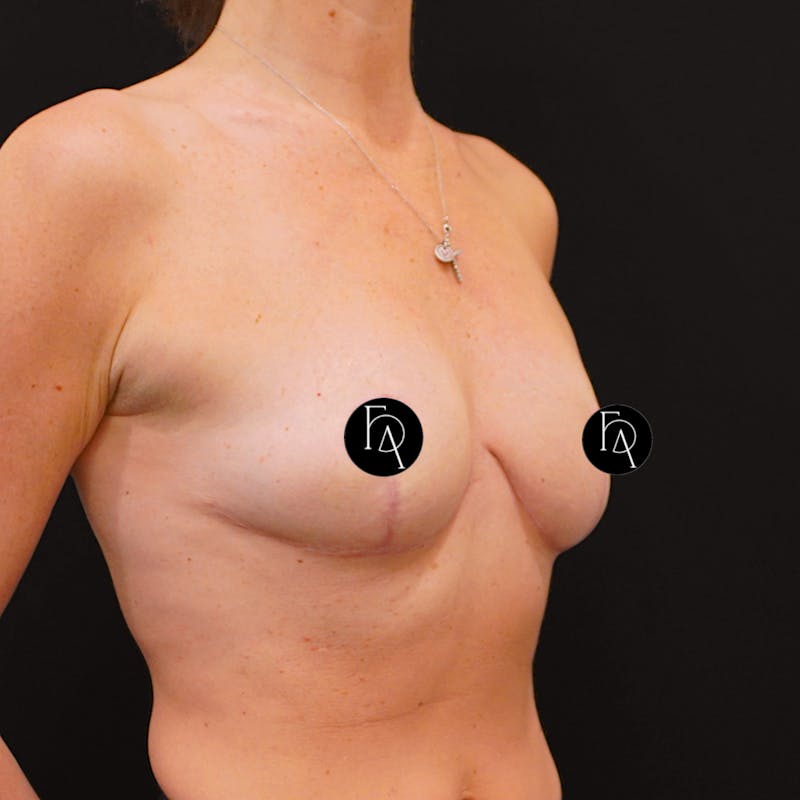 Breast Reduction Before & After Gallery - Patient 386259 - Image 4